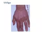 Vitiligo - slide 1