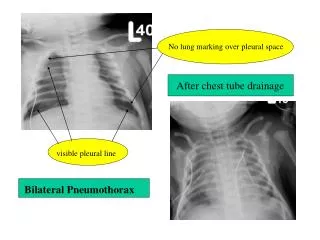 Bilateral Pneumothorax