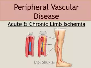 Peripheral Vascular Disease Acute &amp; Chronic Limb Ischemia