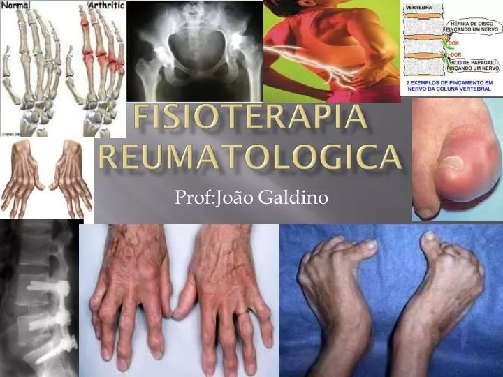 fisioterapia reumatologica
