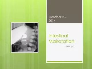 intestinal malrotation