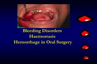 Bleeding Disorders Haemostasis Hemorrhage in Oral Surgery