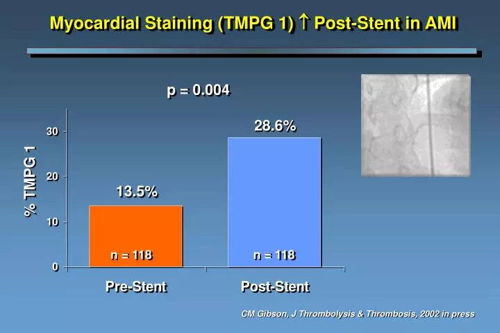 myocardial staining tmpg 1 post stent in ami
