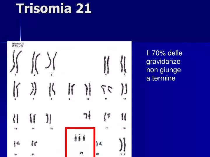 trisomia 21