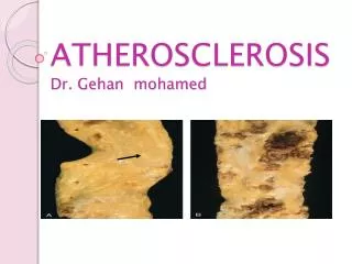ATHEROSCLEROSIS Dr. Gehan mohamed