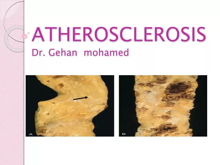 atherosclerosis dr gehan mohamed