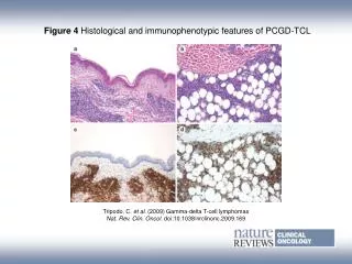 Figure 4 Histological and immunophenotypic features of PCGD?TCL