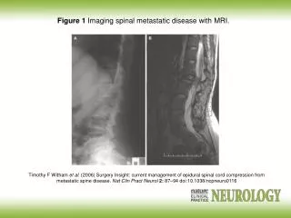 Figure 1 Imaging spinal metastatic disease with MRI.