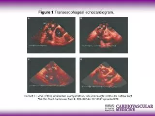 Figure 1 Transesophageal echocardiogram.