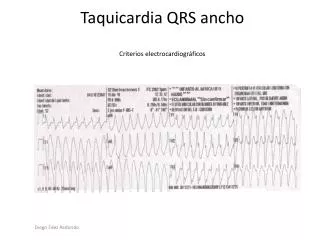 Taquicardia QRS ancho Criterios electrocardiográficos