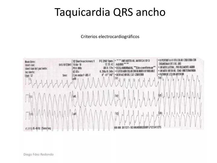taquicardia qrs ancho criterios electrocardiogr ficos