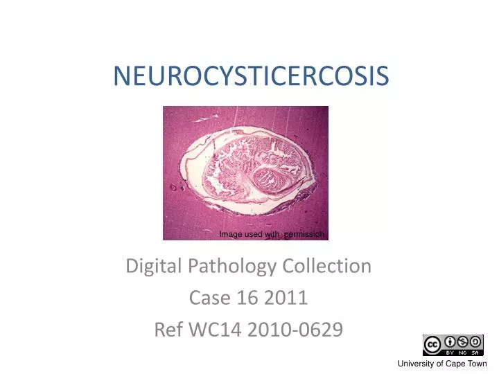 neurocysticercosis