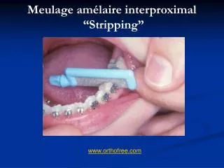 Meulage amélaire interproximal “Stripping”