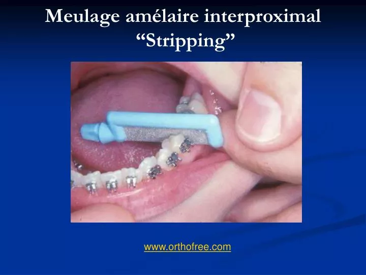 meulage am laire interproximal stripping