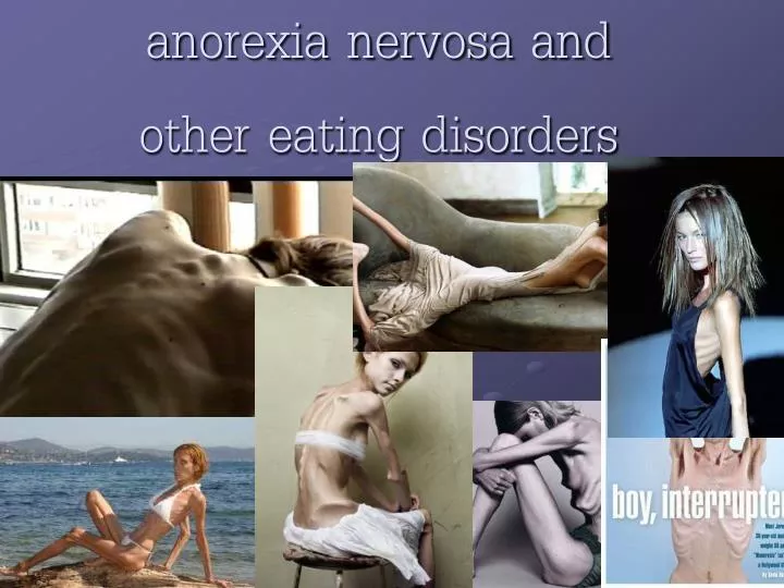 anorexia nervosa and other eating disorders