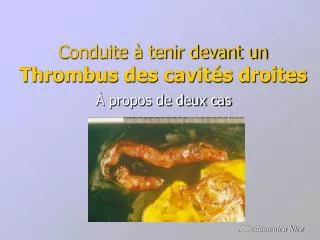 conduite tenir devant un thrombus des cavit s droites