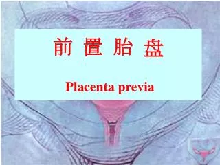 placenta previa