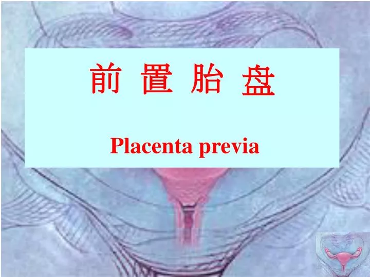 placenta previa