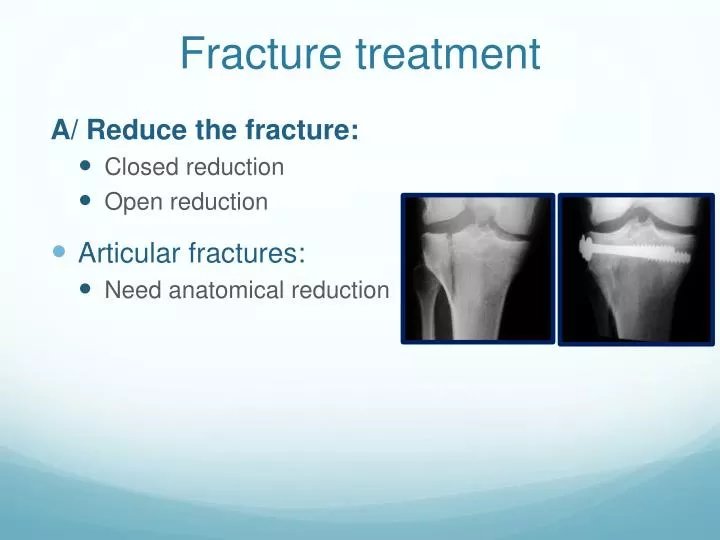 fracture treatment