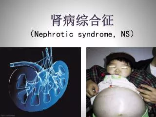 nephrotic syndrome ns