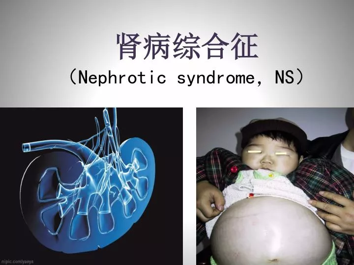 nephrotic syndrome ns