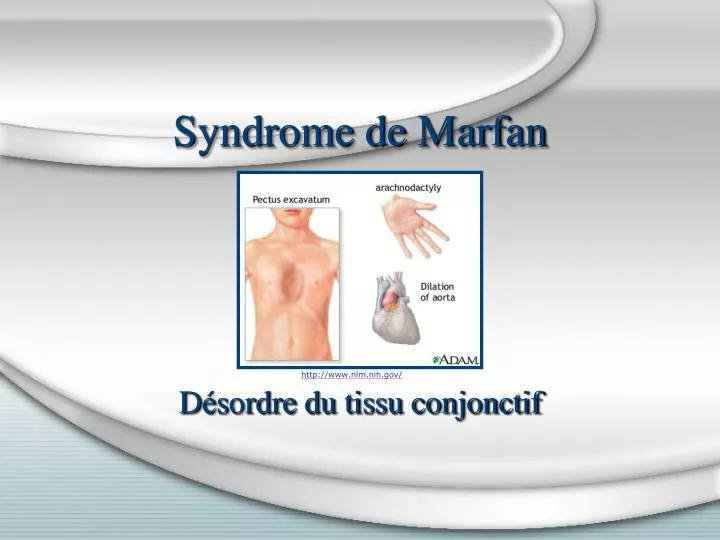 syndrome de marfan