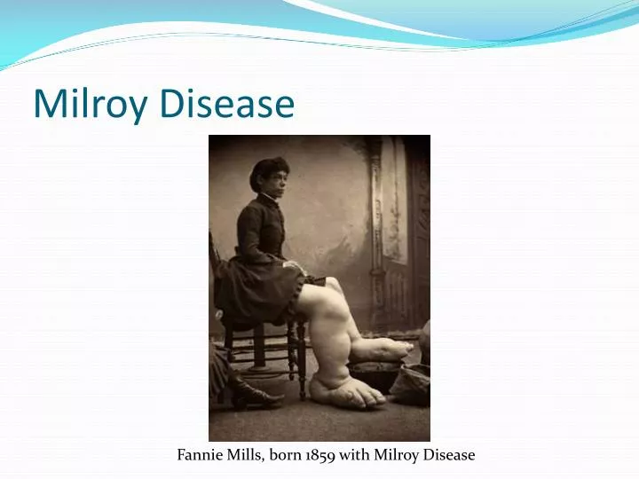 milroy disease
