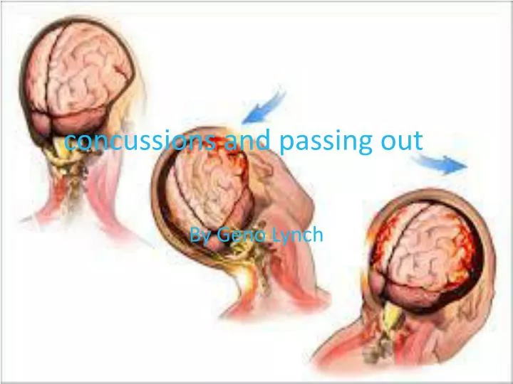 concussions and passing out