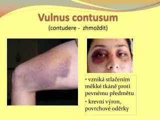 vulnus contusum contudere zhmo dit