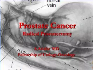 Prostate Cancer Radical Prostatectomy