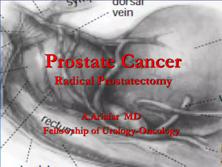 prostate cancer radical prostatectomy