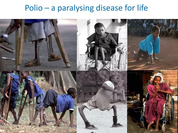polio a paralysing disease for life