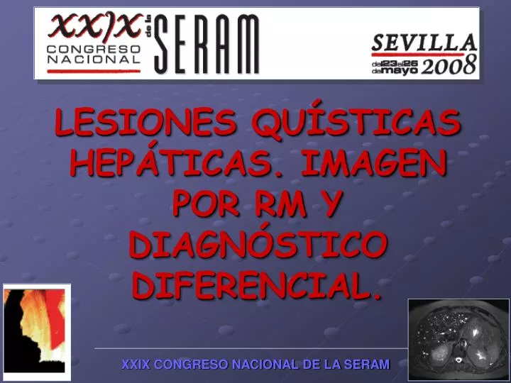 lesiones qu sticas hep ticas imagen por rm y diagn stico diferencial