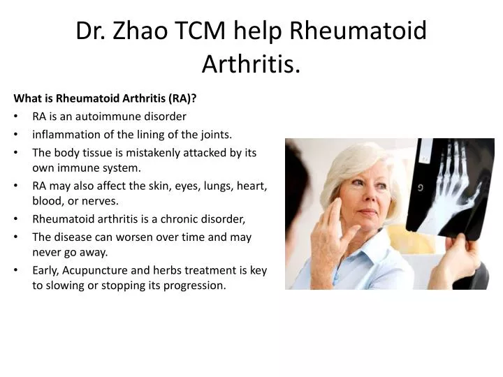 dr zhao tcm help rheumatoid arthritis