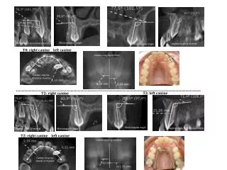 Sagittal angle &amp; vertical position