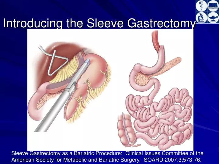 introducing the sleeve gastrectomy