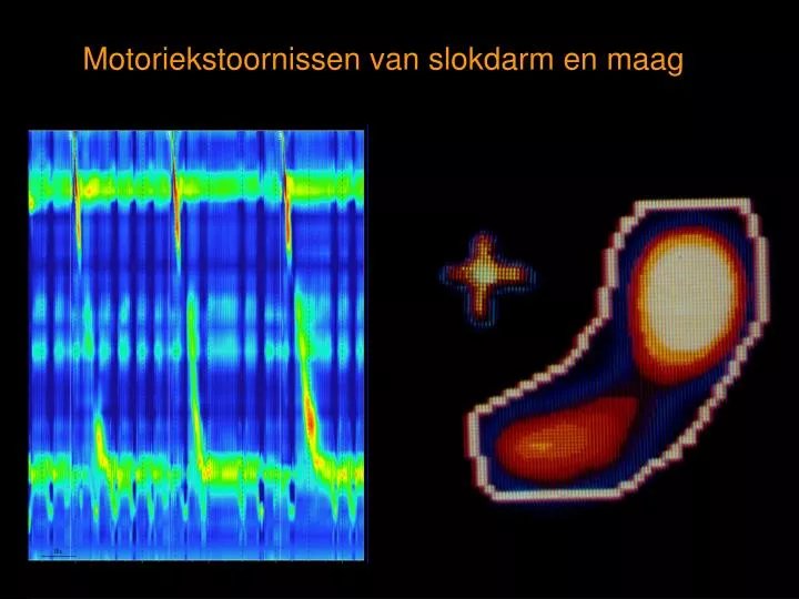 motoriekstoornissen van slokdarm en maag