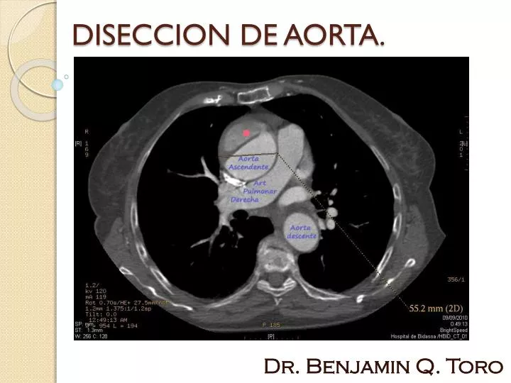 diseccion de aorta