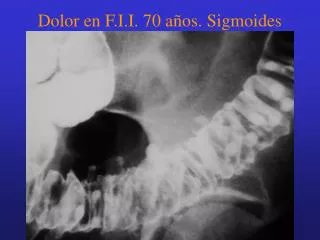 dolor en f i i 70 a os sigmoides