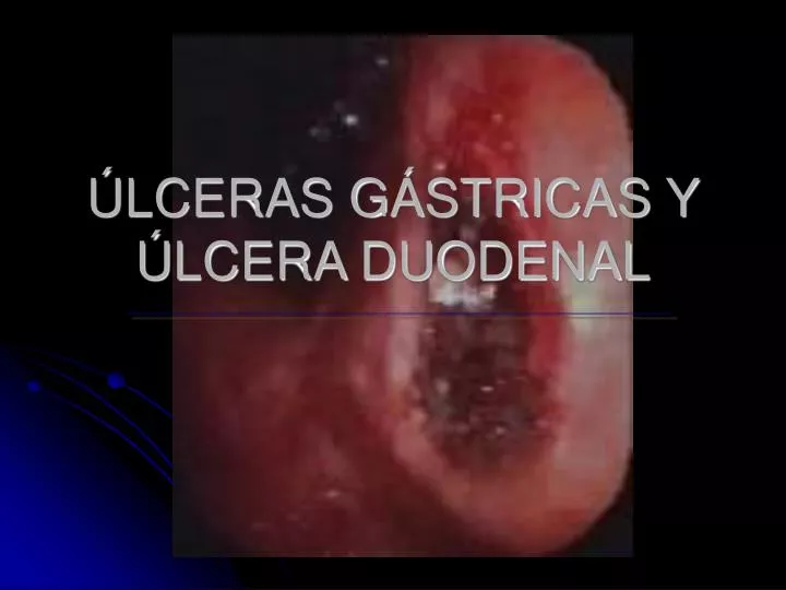 lceras g stricas y lcera duodenal