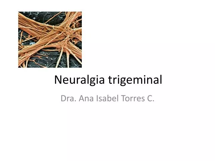 neuralgia trigeminal