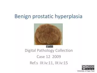 Benign prostatic hyperplasia