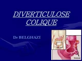 diverticulose colique