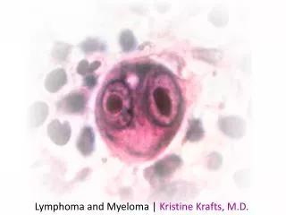 Lymphoma and Myeloma | Kristine Krafts, M.D.