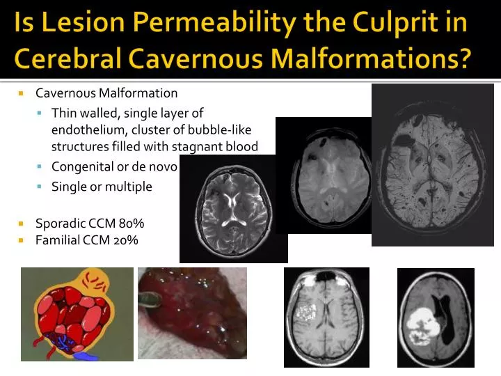 is lesion permeability the culprit in cerebral cavernous malformations