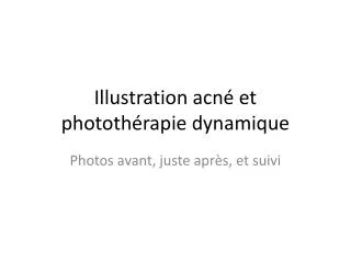 illustration acn et phototh rapie dynamique