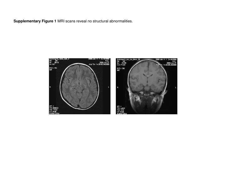 supplementary figure 1 mri scans reveal no structural abnormalities