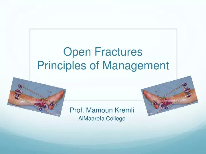 open fractures principles of management