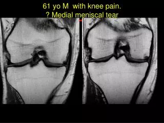 61 yo M with knee pain. ? Medial meniscal tear