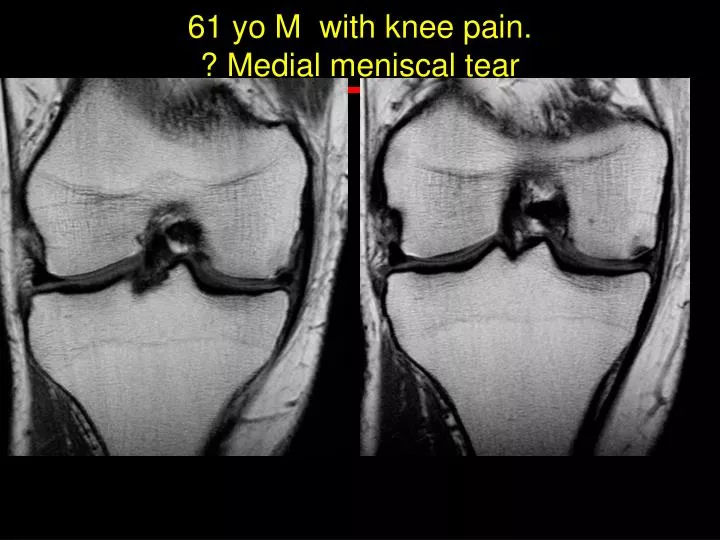 61 yo m with knee pain medial meniscal tear